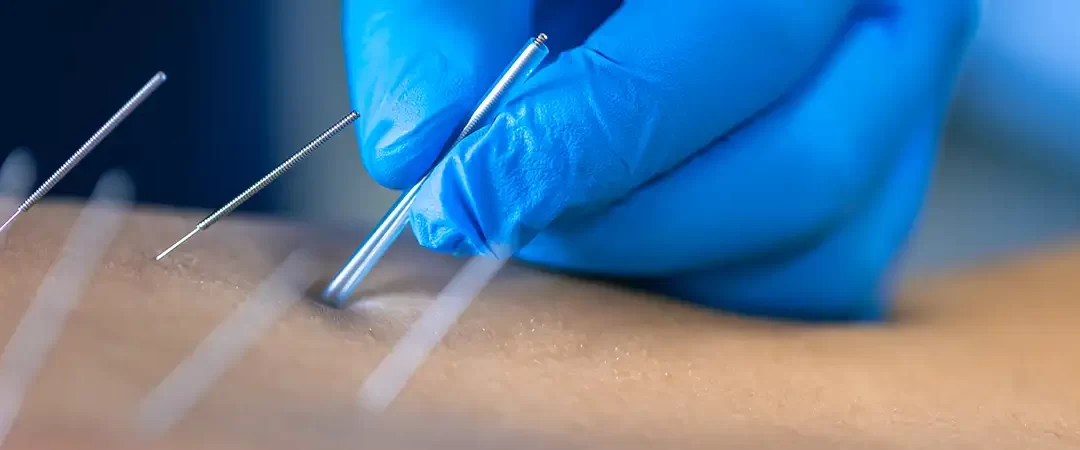 AGOPUNTURA: una terapia veramente personalizzata?